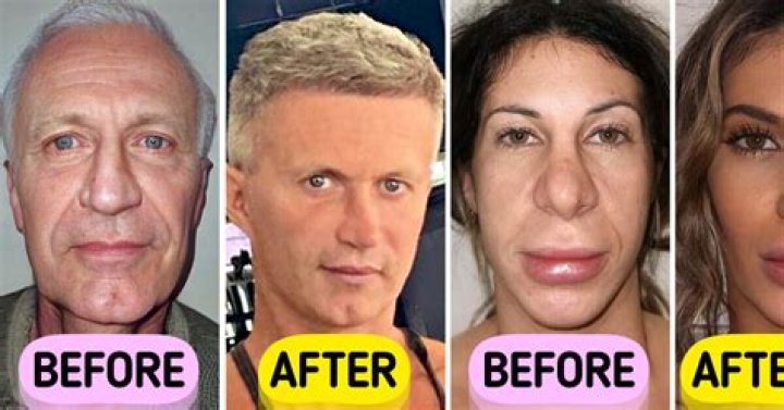 Plastic Surgery Transformations Of Kathy May Fritz