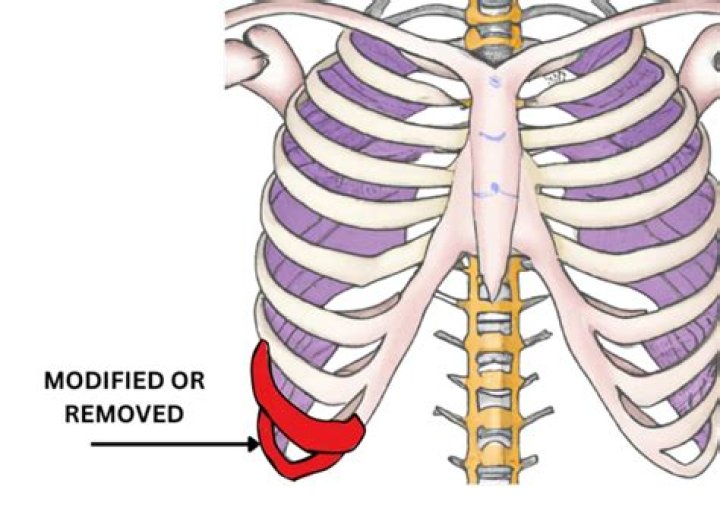 Transformations In Focus: Rib Removal Before After